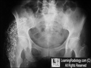 Calcified hematoma